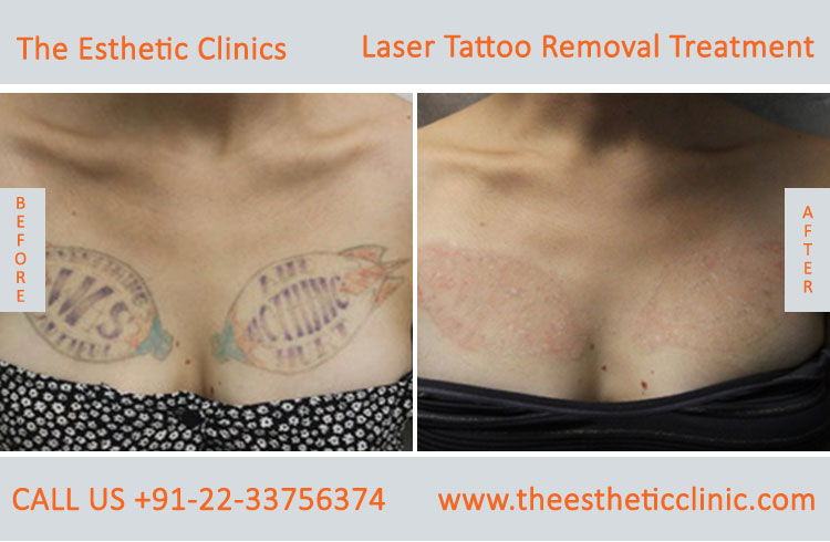 Permanent Laser Tattoo Removal Treatment before after photos in mumbai india (4)